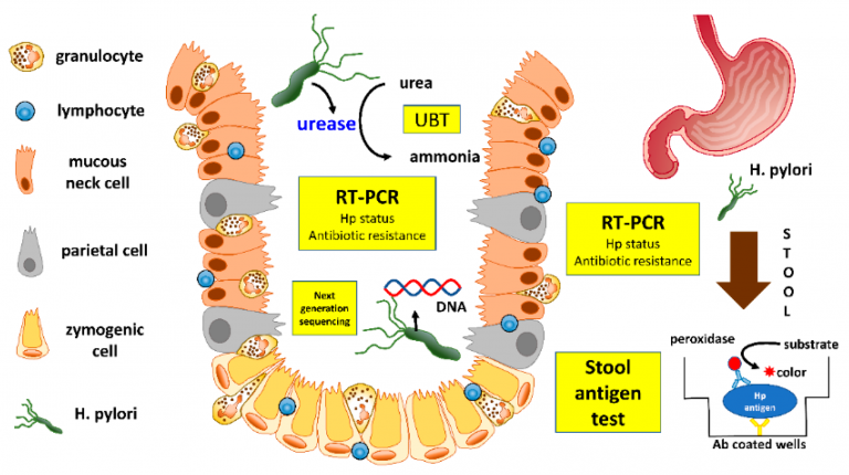 Helicobacter Pylori Detection Method-Invasive Detection