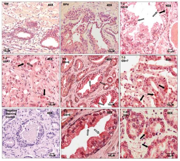 Cxcr5 Expressed By Prostate Cancer Specimens Creative Diagnostics