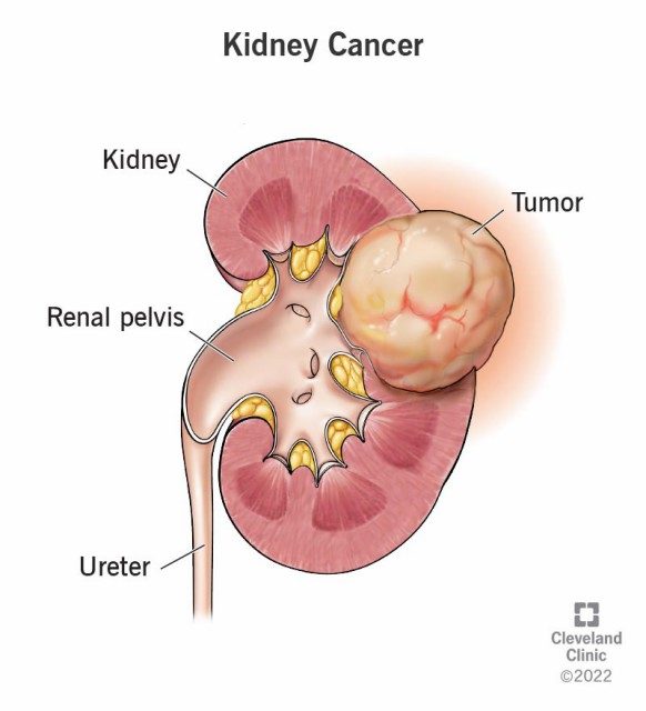 kidney-cancer-creative-diagnostics