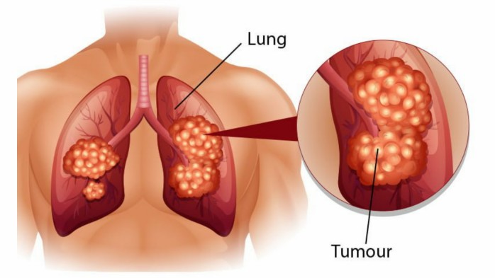 Lung Cancer - Creative Diagnostics