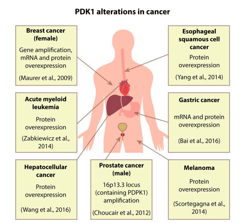 PDK-1 alterations in cancer