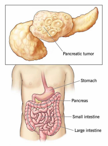 Pancreatic Cancer Creative Diagnostics 8293