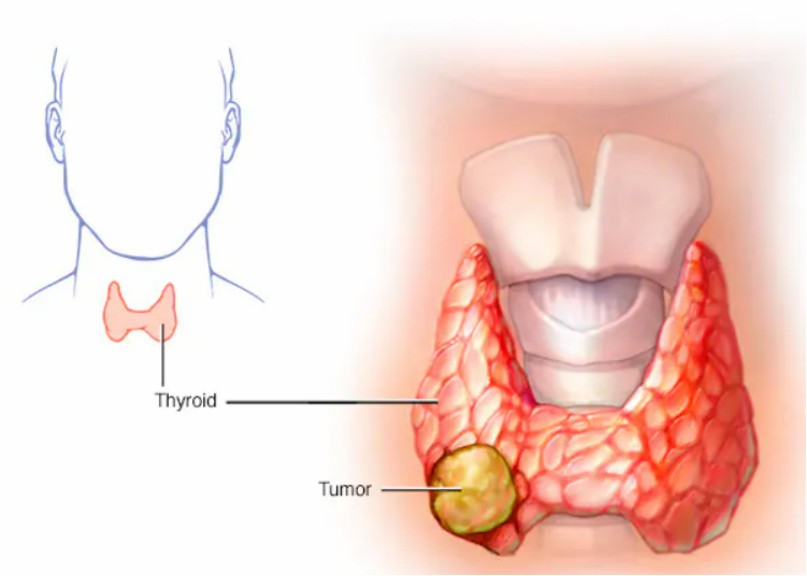 Papillary Thyroid Cancer Creative Diagnostics