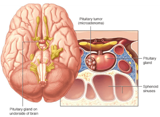 Pituitary Gland Tumor Creative Diagnostics 7971